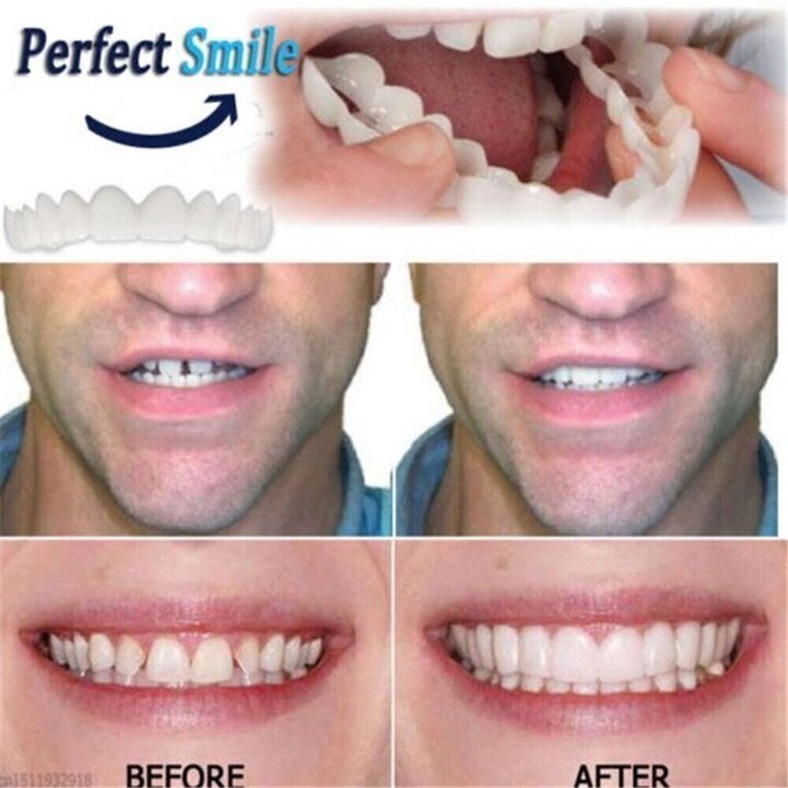 💝Last day discount-60%Off💝Latest👨⚕Adjustable Snap-On Dentures😁