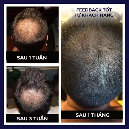 OUHOE Natural Hair Regrowth Spray